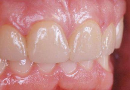 Cerec Frontzahnästhetikkurs für Fortgeschrittene in Berlin